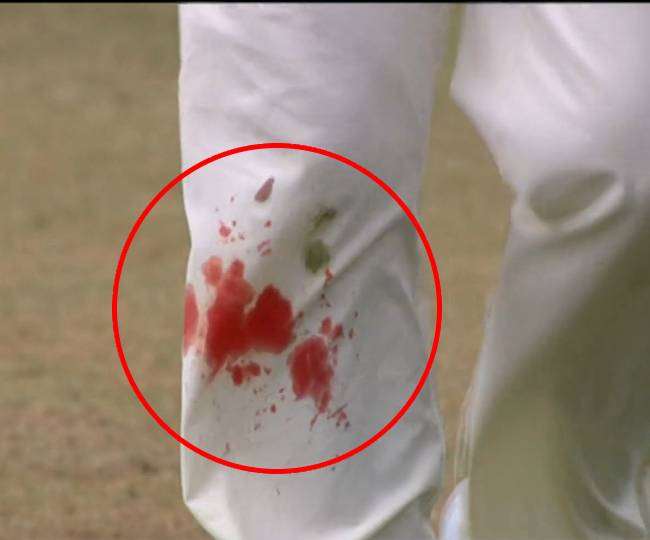 जेम्स एंडरसन ने घुटने से खून बहने के बावजूद जारी रखी गेंदबाजी, कैसे लगी अंग्रेज दिग्गज के चोट; सोशल मीडिया पर वायरल हुई फोटो