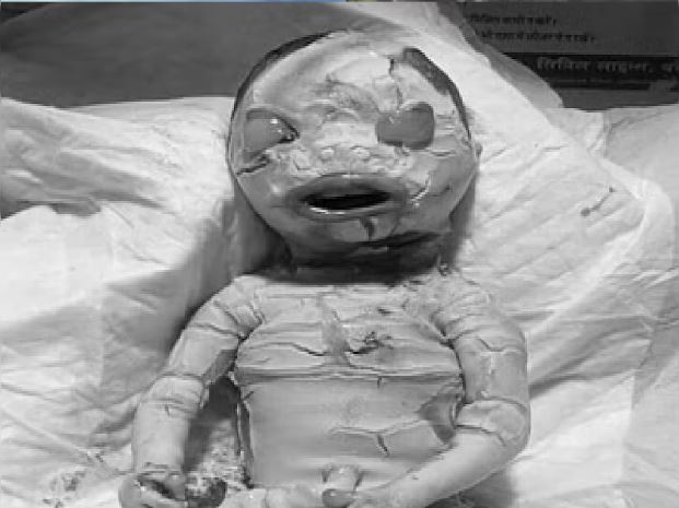 बरेली में एलियन जैसी दिखने वाली दुर्लभ बच्ची का जन्म, सफेद शरीर के साथ निकले थे दांत